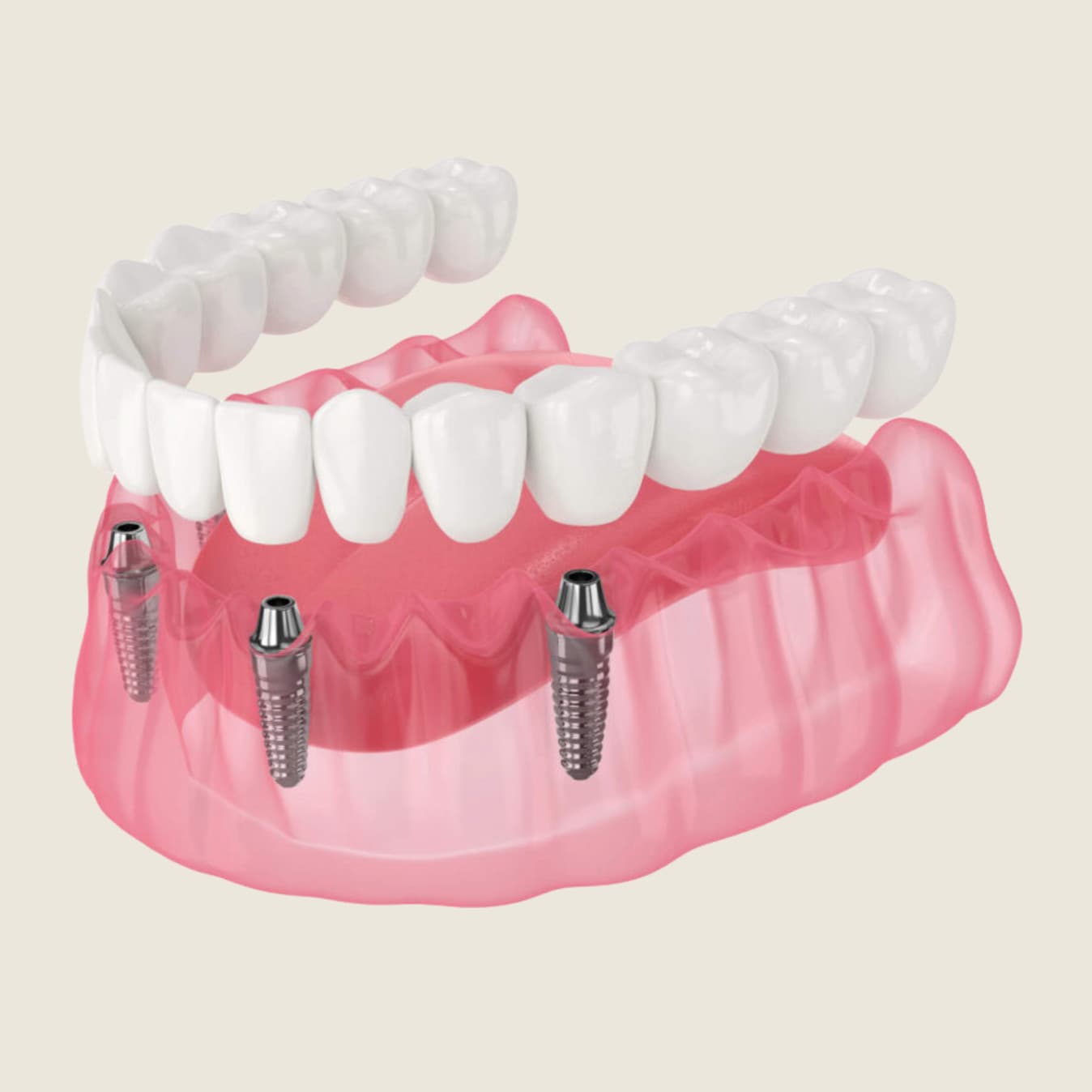 All on X full arch implant prosthesis restoring a complete smile at Rancho Bernardo Dental Arts