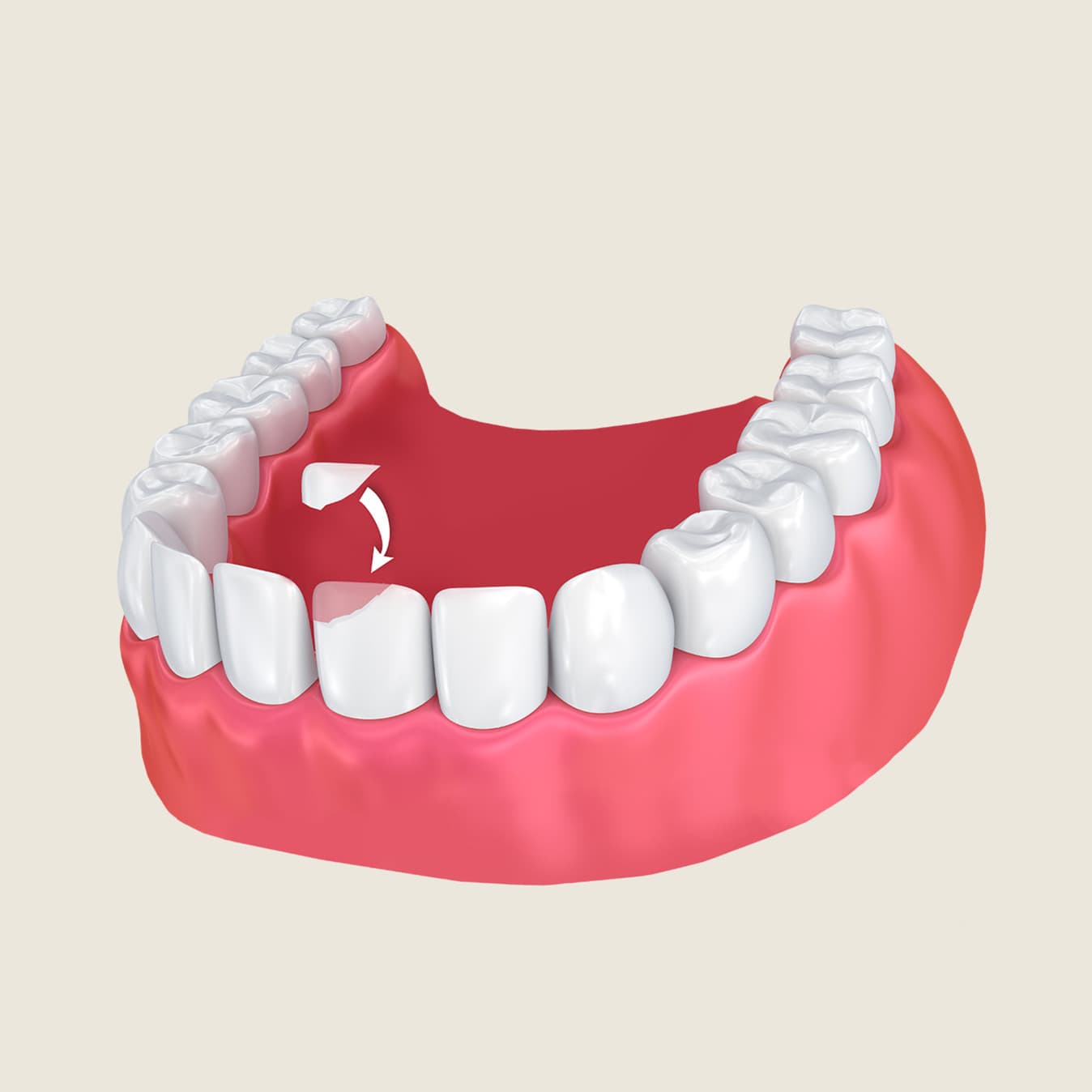Cosmetic dental bonding repairing a chipped front tooth at Rancho Bernardo Dental Arts