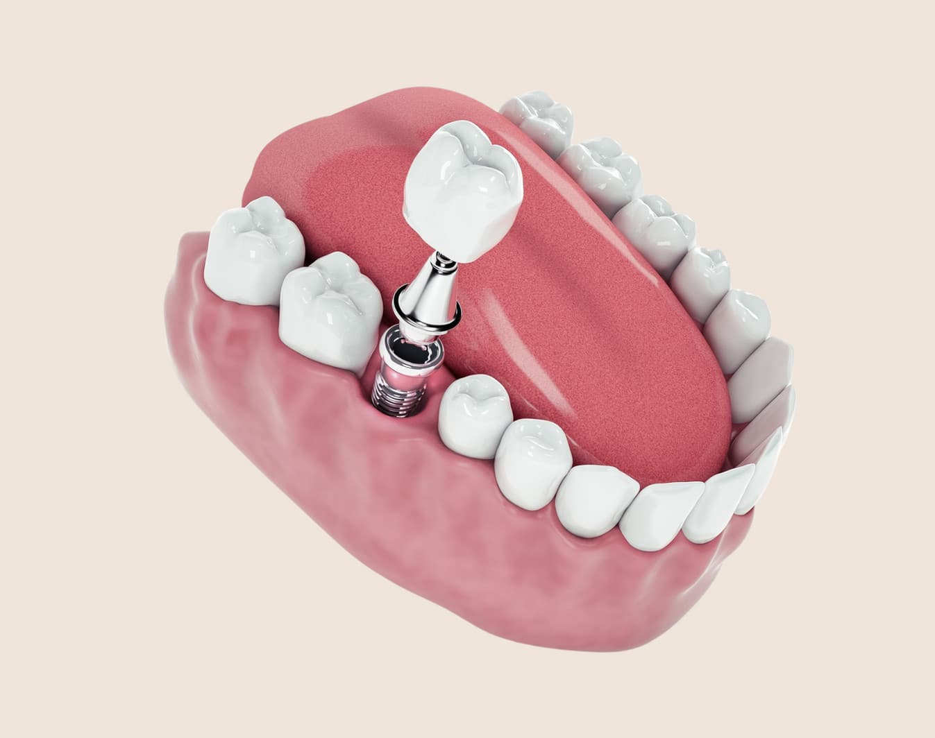 Dr. Ghandehari reviewing dental implant treatment with a patient at Rancho Bernardo Dental Arts