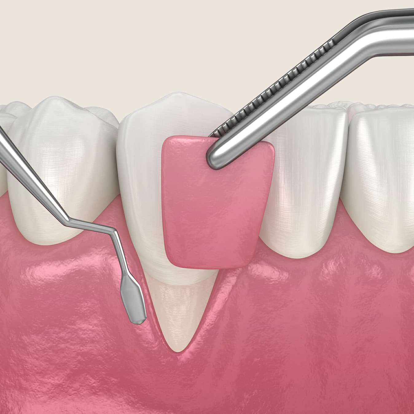 Gum grafting procedure restoring receded tissue at Rancho Bernardo Dental Arts