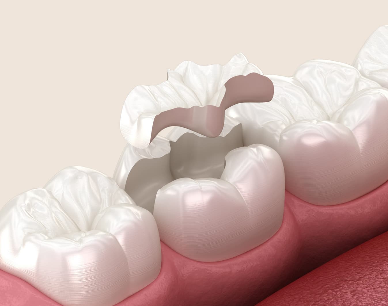 Dentist repairing a lost filling promptly at Rancho Bernardo Dental Arts in San Diego