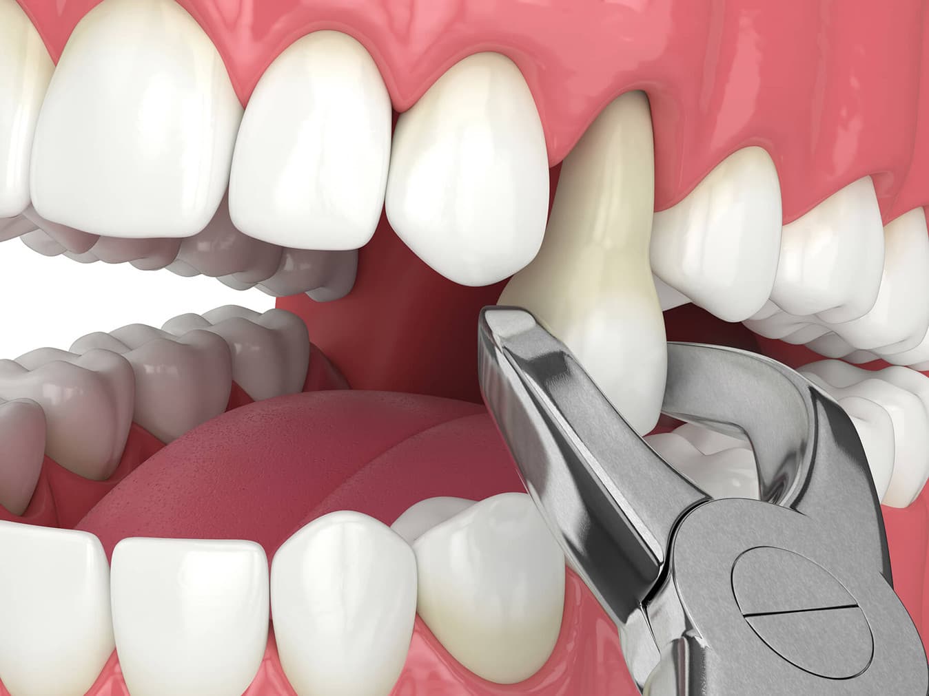 Gentle surgical tooth extraction performed at Rancho Bernardo Dental Arts in San Diego