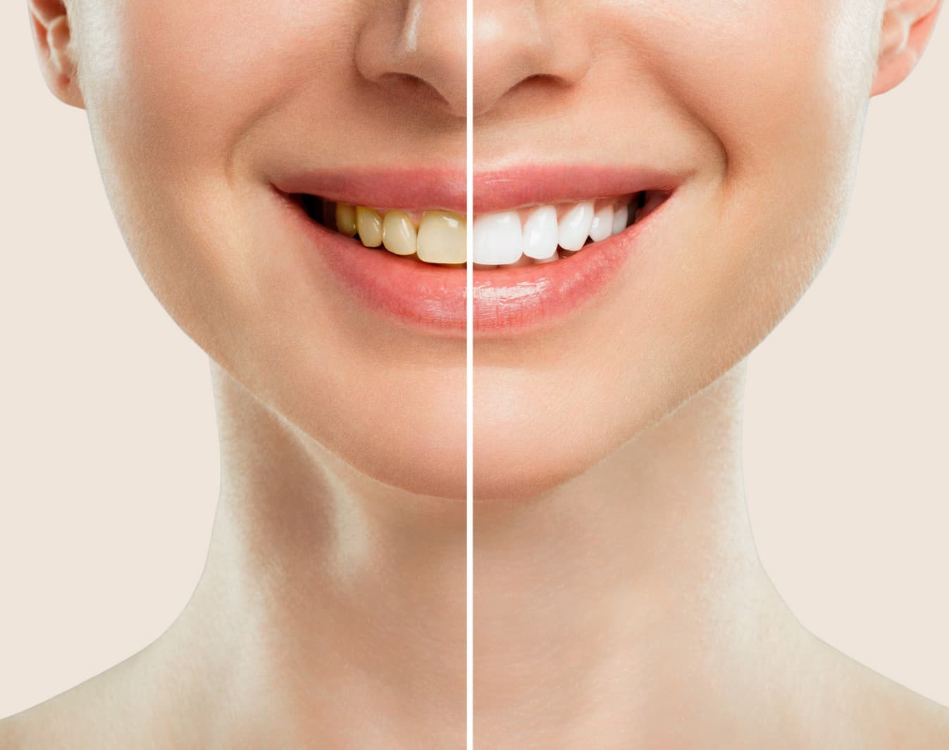 Patient with a brilliantly whitened smile after treatment at Rancho Bernardo Dental Arts