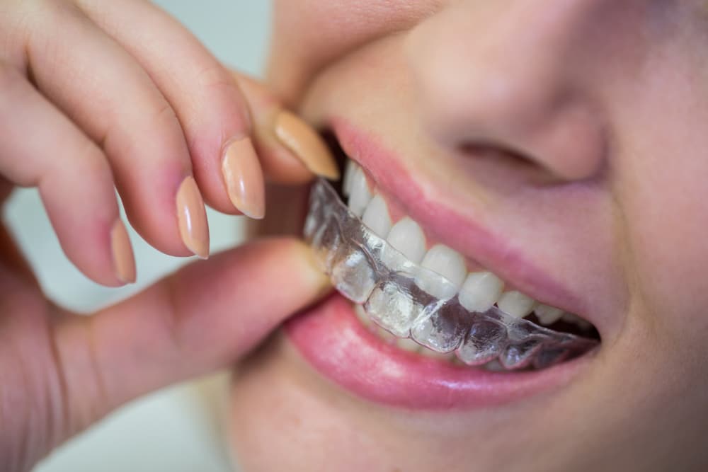 Invisalign in Rancho Bernardo: How Clear Aligners Fit Into a Modern Cosmetic Smile Plan