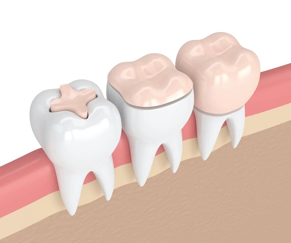 Dentist showing a patient the difference between a crown and a filling at Rancho Bernardo Dental Arts