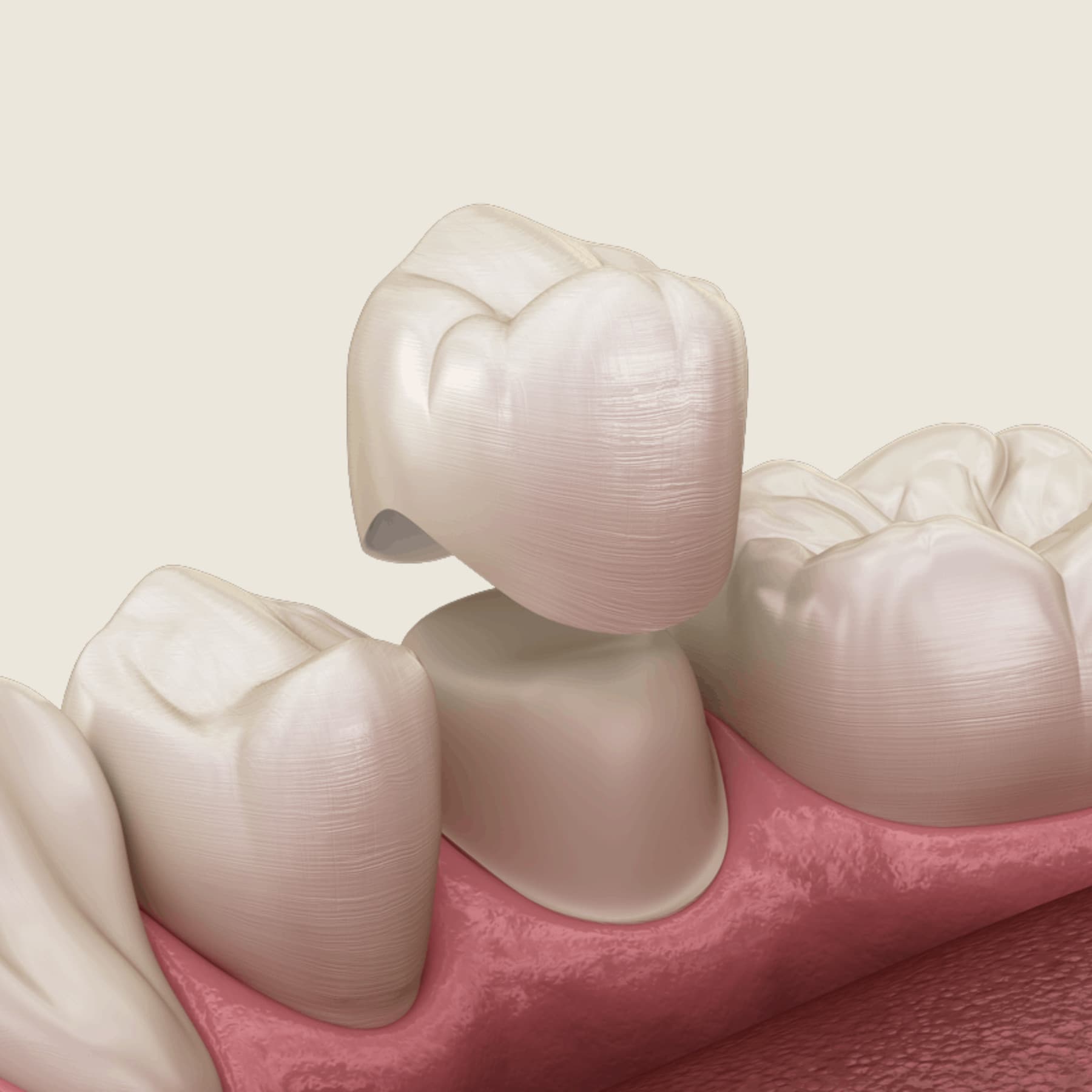 Same day dental crown being milled in office at Rancho Bernardo Dental Arts